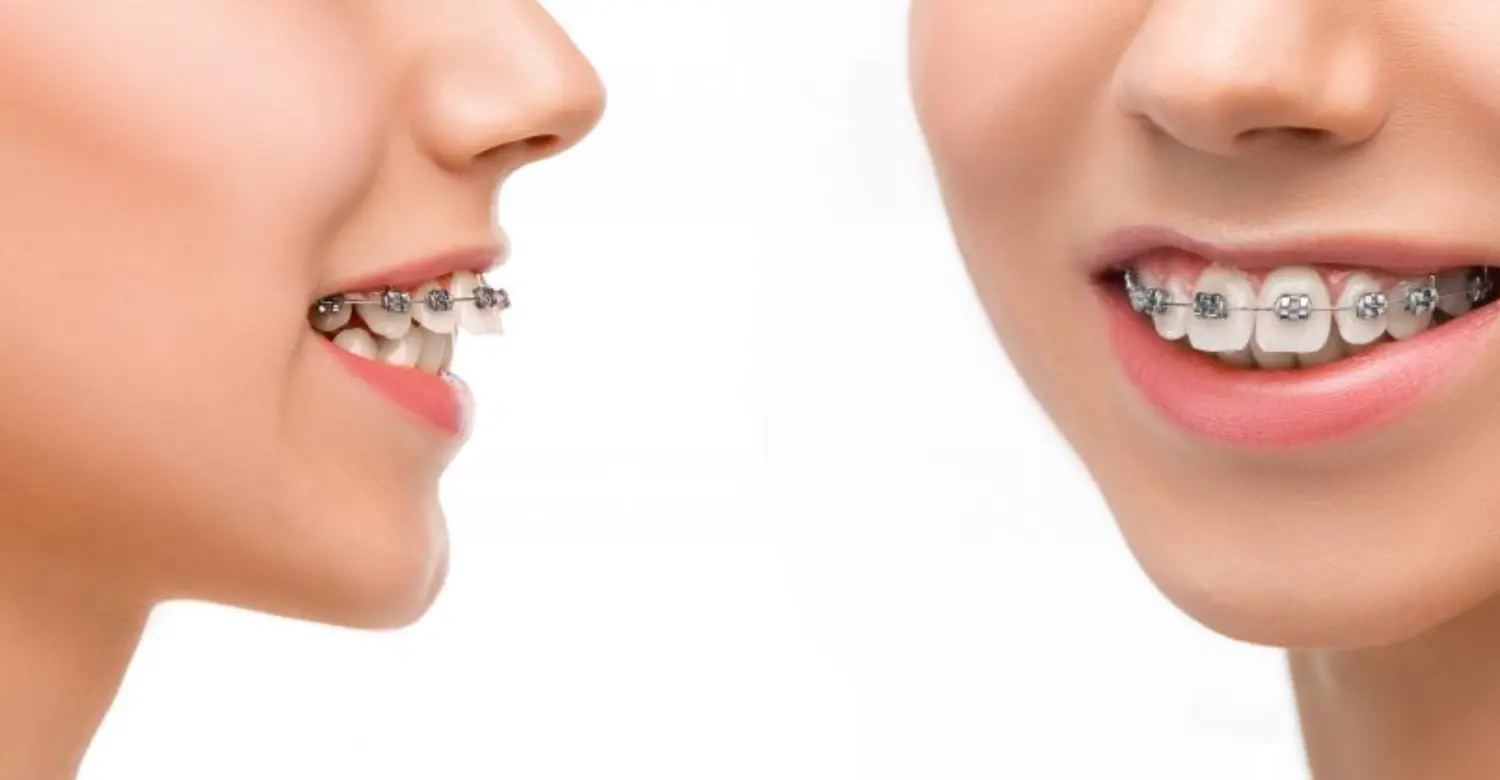 Orthodontic Treatment Plan 2